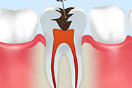 Step1歯冠の虫歯部位の除去