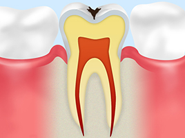 【C1：エナメル質の虫歯】