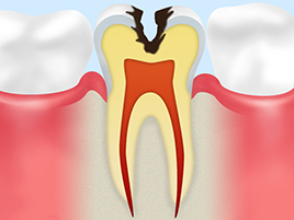 【C2：象牙質の虫歯】