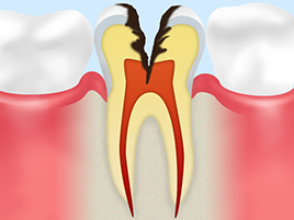 【C3：神経に達した虫歯】