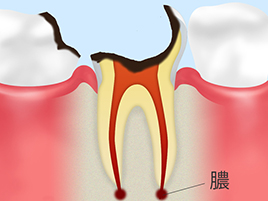 【C4：歯根に達した虫歯】