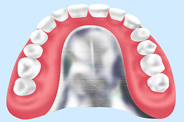 金属床義歯