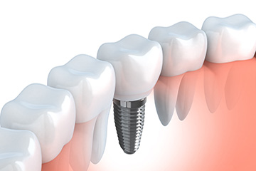 インプラント治療について