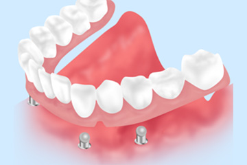 インプラント義歯（オーバーデンチャー）