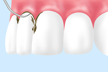 歯のクリーニングの重要性