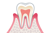 Stage2歯肉炎（軽度）