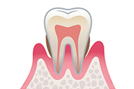 Stage3歯肉炎（中度）