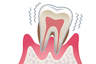 Stage4歯肉炎（重度）